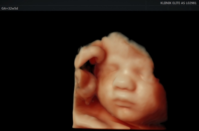 32+5_ultrasound_photo_EliteKliinik